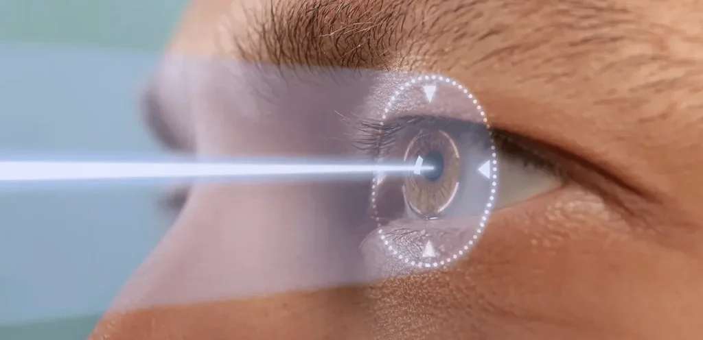 Les dernières avancées en chirurgie réfractive : Tout savoir sur la correction au laser